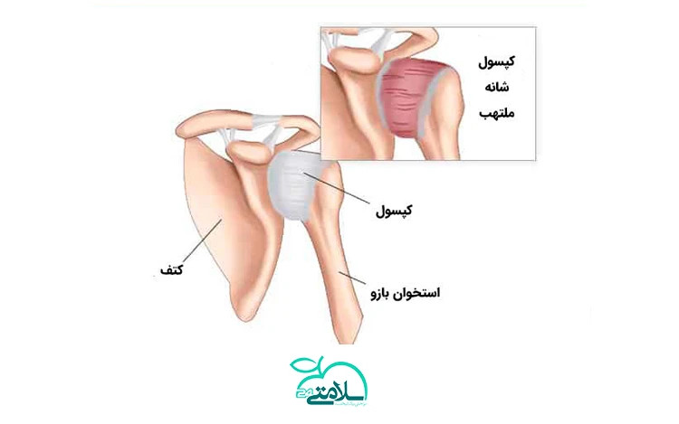 تما آنچه که باید درباره شانه یخ زده و راه های درمان آن بدانید